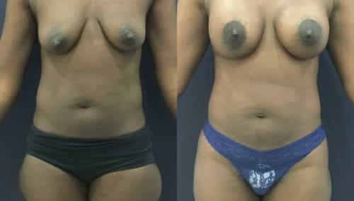 breast lift colombia 343 - 1-min