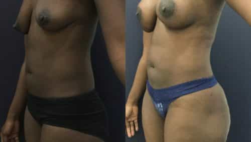 breast lift colombia 343 - 2-min