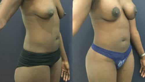 breast lift colombia 343-3-min