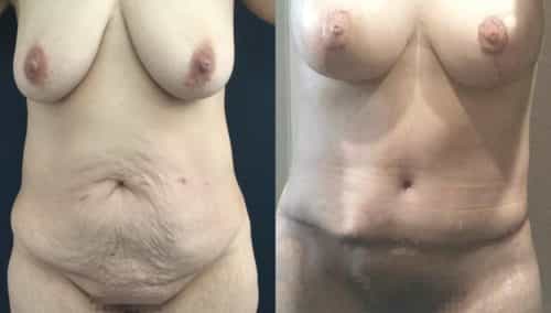 breast lift colombia 354-1-min