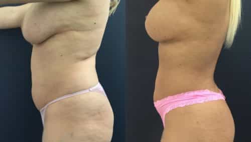 breast lift colombia 358 - 2-min