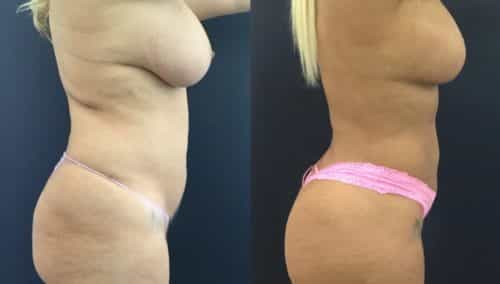 breast lift colombia 358 - 3-min