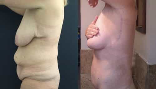 breast lift colombia 389-2-min