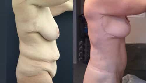 breast lift colombia 389-3-min