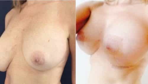 breast revision colombia 236 - 2