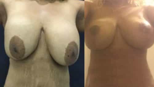 breast revision colombia 291 - 2