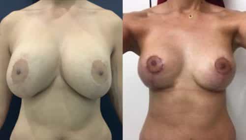 breast revision colombia 341 - 1