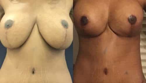 breast revision colombia 357 - 1