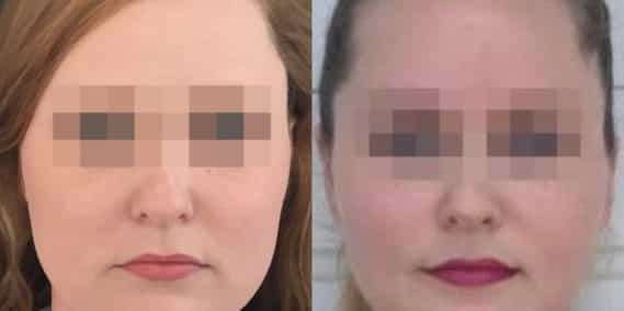 buccal fat pad excision Colombia 203 - 1-min
