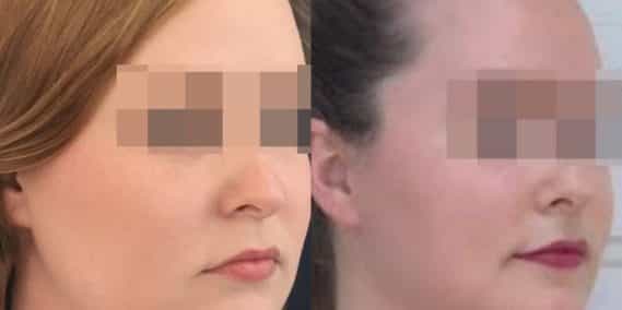 buccal fat pad excision Colombia 203 - 2-min