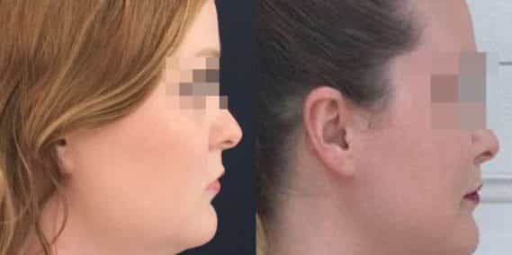 buccal fat pad excision Colombia 203 - 3-min
