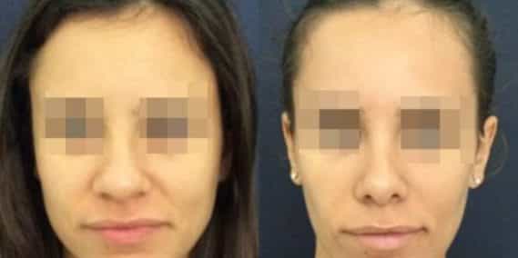buccal fat pad excision Colombia 212 - 1-min