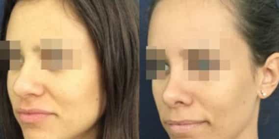 buccal fat pad excision Colombia 212 - 2-min