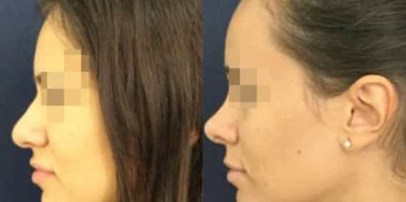 buccal fat pad excision Colombia 212 - 3-min