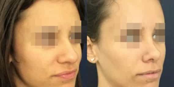 buccal fat pad excision Colombia 212 - 4-min