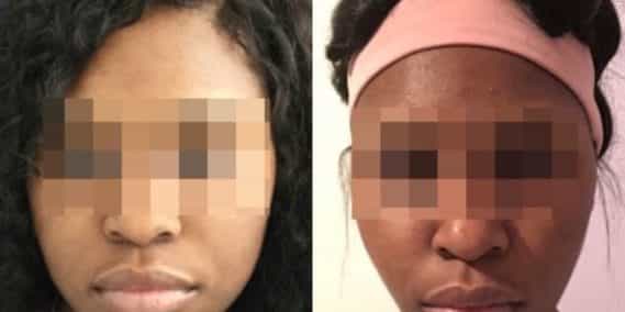 buccal fat pad excision Colombia 224 - 1-min