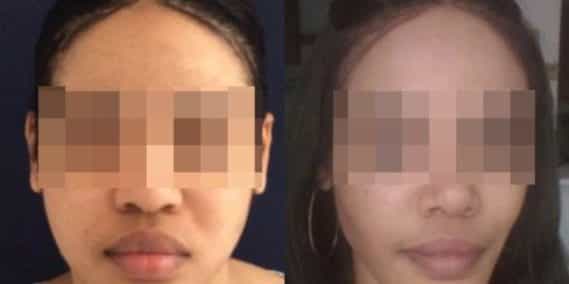 buccal fat pad excision Colombia 267 - 1-min