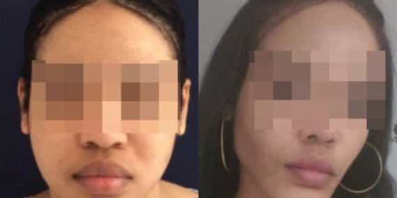 buccal fat pad excision Colombia 267 - 2-min