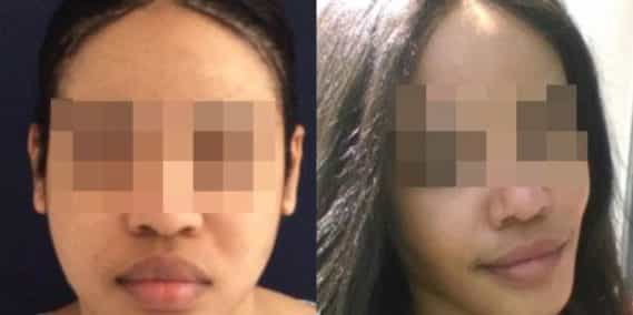 buccal fat pad excision Colombia 267 - 3-min