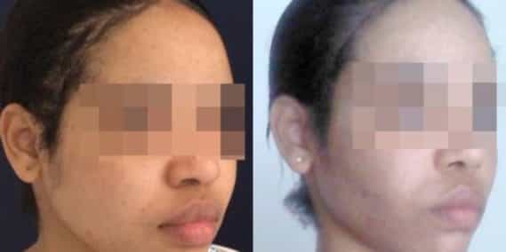 buccal fat pad excision Colombia 267 - 4-min