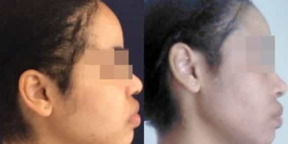 buccal fat pad excision Colombia 267 - 5-min