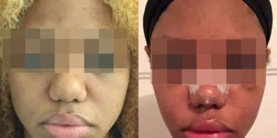 buccal fat pad excision Colombia 317 - 1-min