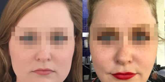 buccal fat pad excision Colombia 333 - 1-min