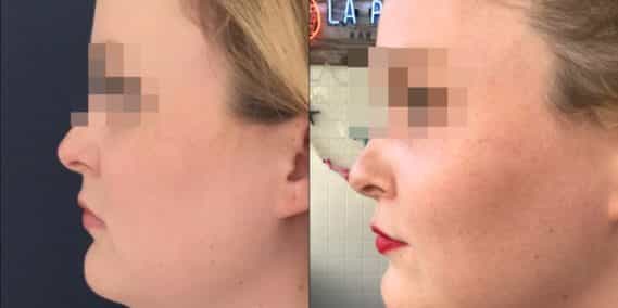 buccal fat pad excision Colombia 333 - 2-min