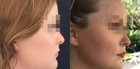 buccal fat pad excision Colombia 333 - 3-min