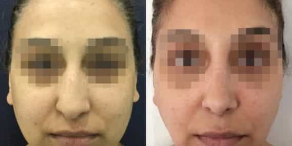 buccal fat pad excision Colombia 342 - 1-min