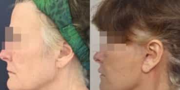 facelift colombia 226 - 3-min