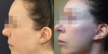 facelift colombia 240 - 3-min