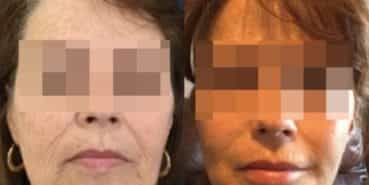 facelift colombia 292 - 1-min