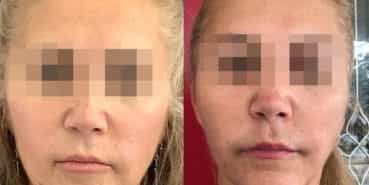 facelift colombia 320 - 1-min