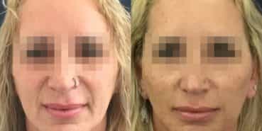 facelift colombia 325 - 1-min