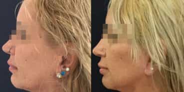 facelift colombia 325 - 5-min