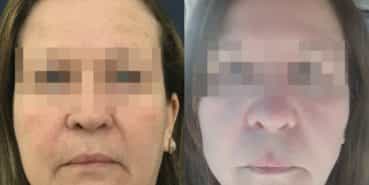 facelift colombia 329 - 1-min