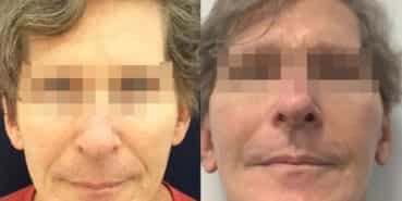 facelift colombia 362 - 1-min