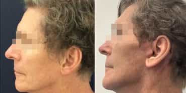 facelift colombia 362 - 3-min
