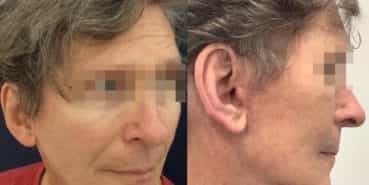 facelift colombia 362 - 4-min