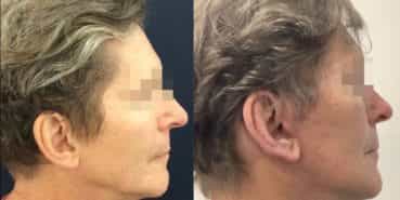 facelift colombia 362 - 5-min
