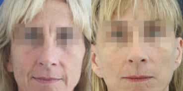facelift colombia 366 - 1-min