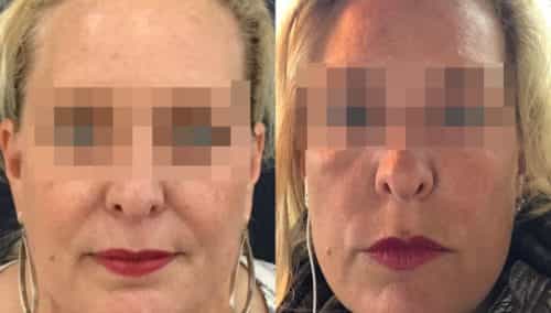 facial fat grafting colombia 106 - 1-min