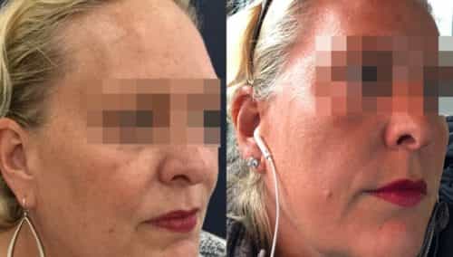 facial fat grafting colombia 106 - 2-min
