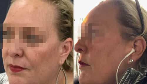 facial fat grafting colombia 106 - 3-min
