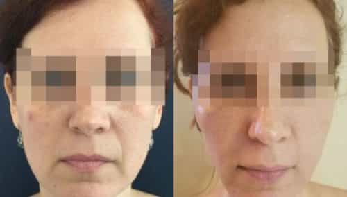 facial fat grafting colombia 217 - 1-min