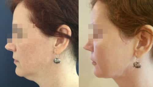 facial fat grafting colombia 217 - 2-min