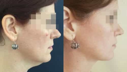 facial fat grafting colombia 217 - 3-min