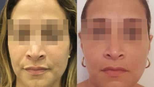 facial fat grafting colombia 286 - 1-min