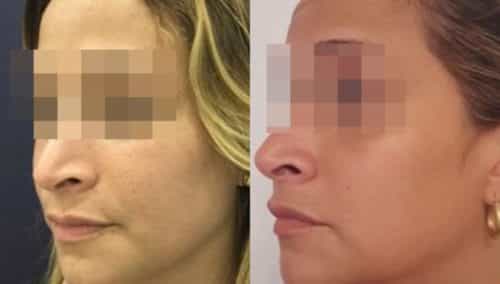 facial fat grafting colombia 286 - 2-min